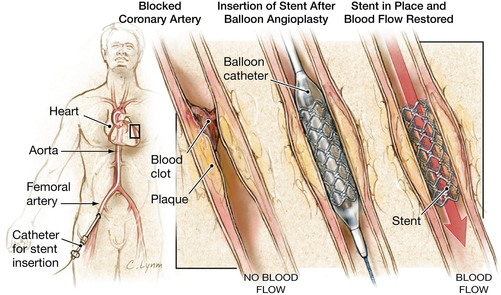 do-angioplasties-and-coronary-stenting-improve-symptoms-in-patients